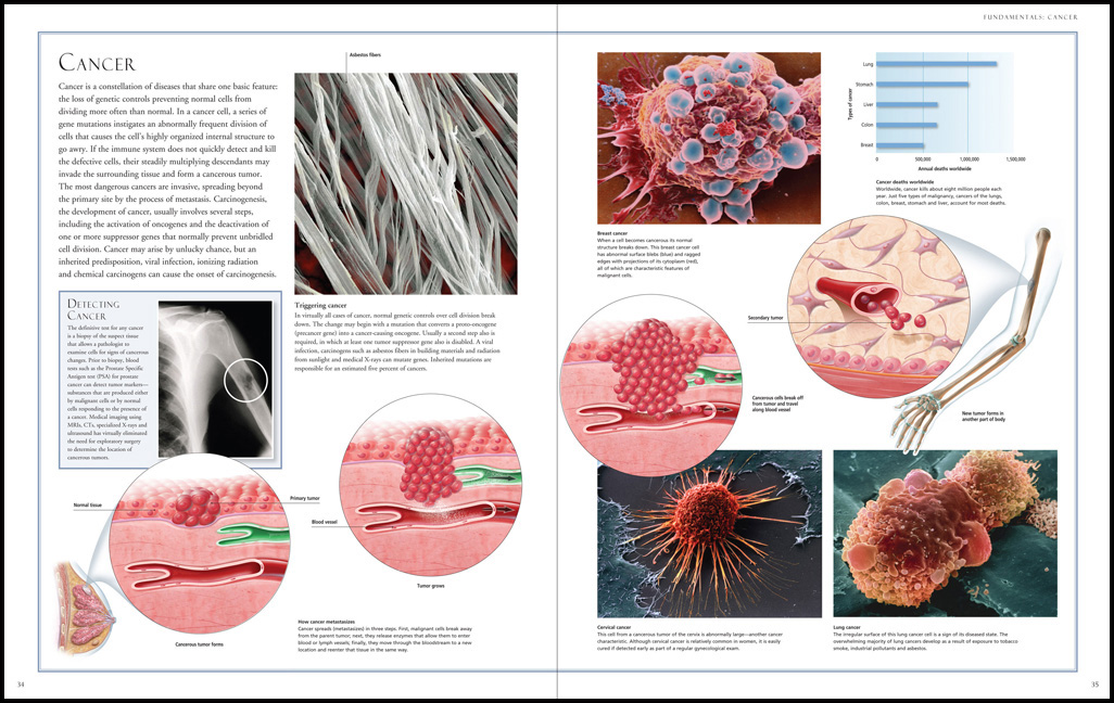 cancer_spread 1